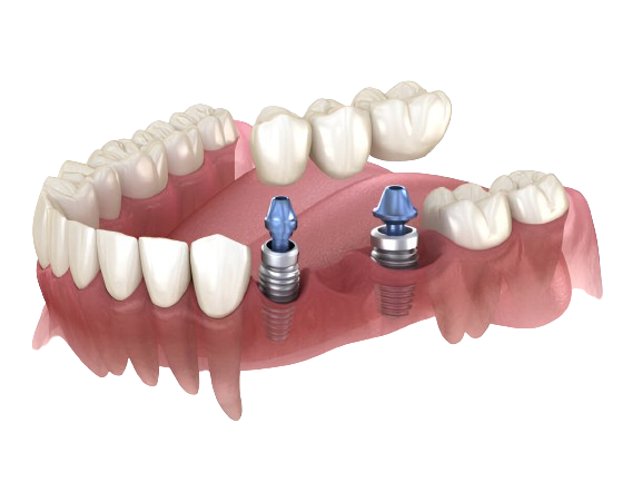 Image of Ceramic Braces